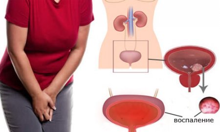 Лечение геморрагического цистита у женщин в домашних условиях thumbnail